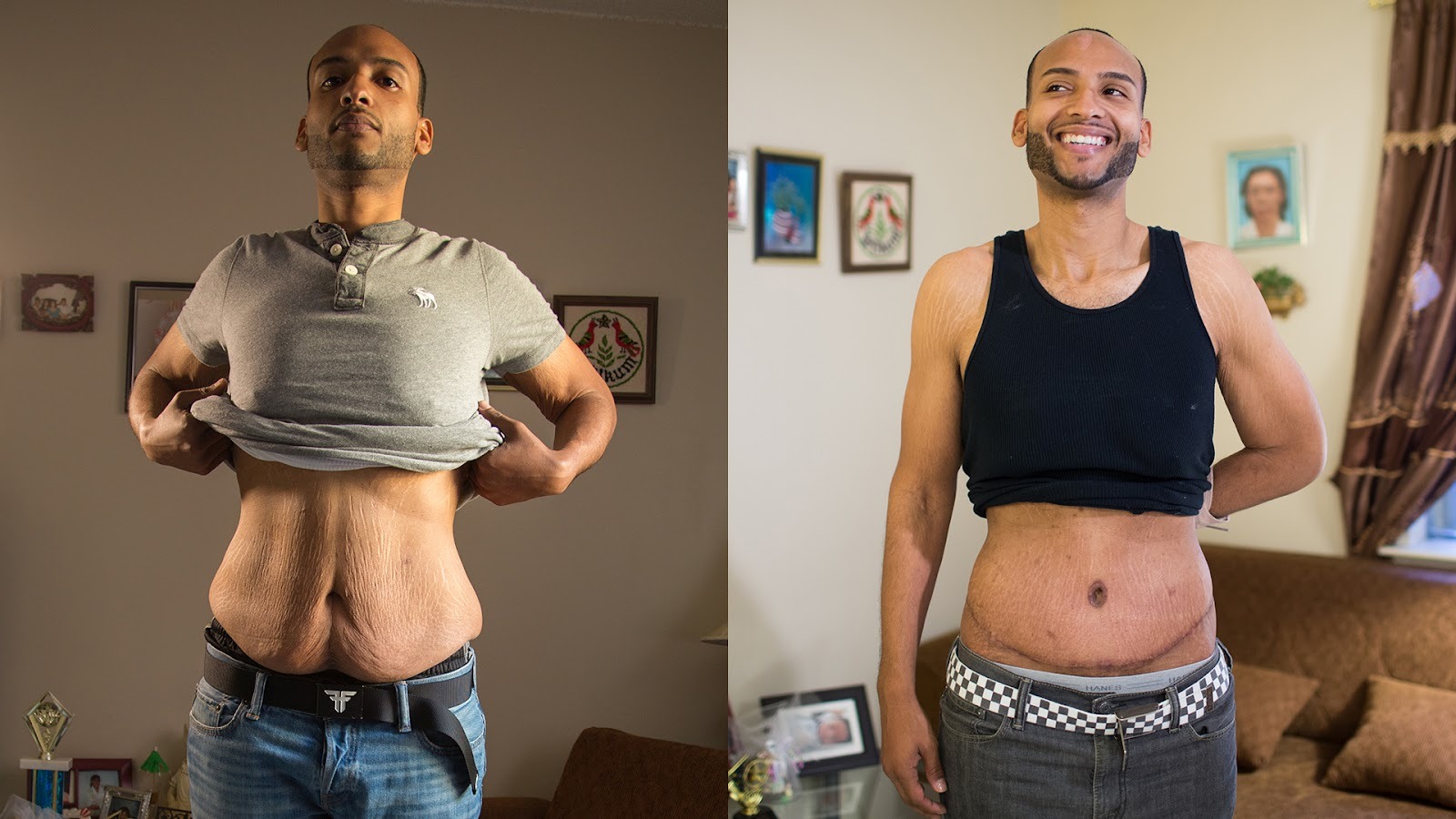 How Can Body Contouring Treatments Improve Results After Significant Weight Loss